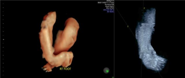 임신 30주에 촬영된 '선천성 만곡족' 태아의 3차원 초음파 사진, 중앙대 광명병원 제공