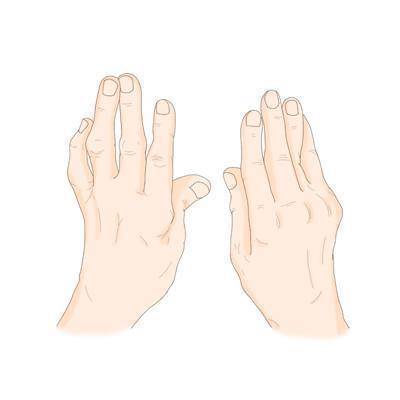 류마티스 관절염 [출처: 삼성서울병원]