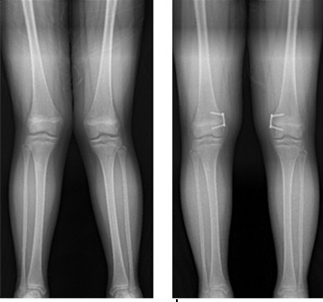 외반슬(엑스자 다리)에 대해 8자 금속판 이용한 대퇴골 내측 반성장판 유합술 후 교정된 환자(좌 교정 전, 우 교정 후) [사진 출처 = 분당서울대병원]