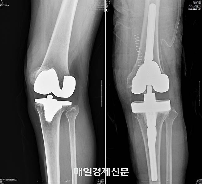 인공관절 재치환술 전(왼쪽)과 후(오른쪽) . 외상으로 인해 축이 비뚤어졌던 무릎이 곧아졌다.