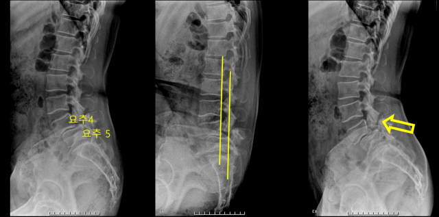 요통 및 하지 방사통으로 2년 이상 치료를 받은 50대 여성의 단순 방사선 사진. 왼쪽 사진과 같이 5번 요추 위의 4번 요추가 앞으로 미끄러져 나와 있는 것이 특징이다. 중간 사진에서 척추체의 가상 후반선 차이가 뚜렷한 것을 확인할 수 있다. 오른쪽 사진에서는 척추분리증 환자의 협부 결손(화살표)이 보인다. 사진 제공=용인세브란스병원