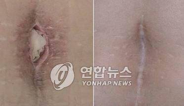 구더기를 이용한 상처 치료 상처 부위가 아물지 않았던 부위에 구더기를 넣이 치료하는 장면(왼쪽)과 구더기 치료 후 상처가 아문 모습(오른쪽). [연합뉴스 자료사진. 재판매 및 DB 금지]