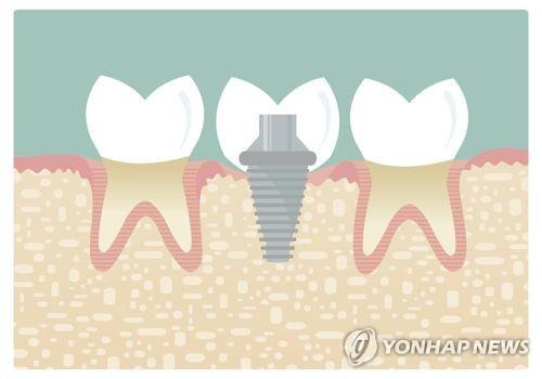 임플란트 [게티이미지뱅크 제공]