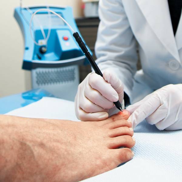 무좀 레이저 치료는 심각한 부작용이 없고, 먹는 무좀약만큼 치료효과가 있다. /헬스조선 DB