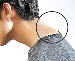 거북목을 방치하면 뒷목 아래 경추 7번 뼈 일부가 돌출될 수 있다./사진=헬스조선DB