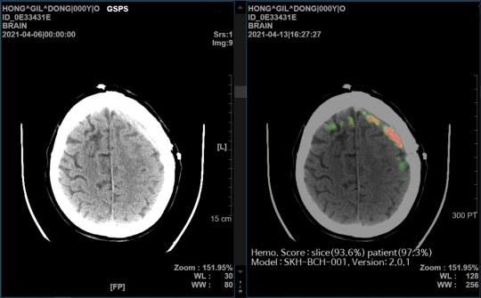 SK(주) C&C AI 뇌출혈 영상 의료솔루션 '메디컬 인사이트 플러스 뇌출혈' 데모 화면. SK(주) C&C 제공