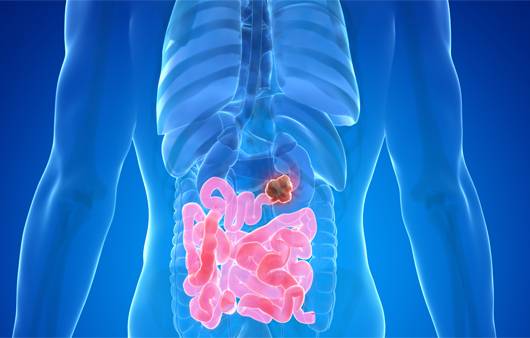 장폐색ㅣ출처: 클립아트코리아