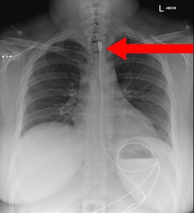 1m 길이의 휴대전화 충전 케이블을 삼킨 여성의 엑스레이(X-ray) 사진. 폴란드 ‘레디 투 레스큐’ 페이스북 캡처