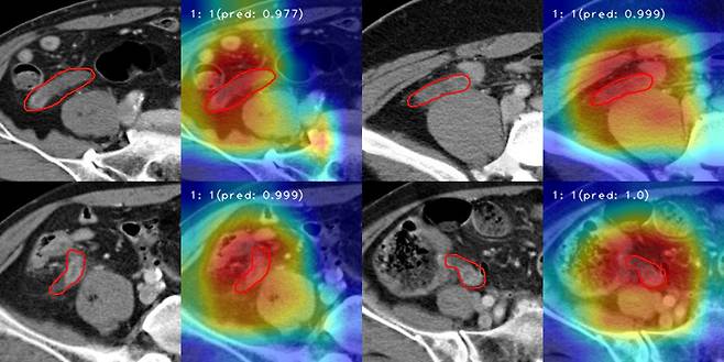 AI(인공지능)가 CT(컴퓨터단층촬영) 영상을 실시간으로 관찰해 충수염을 진단하고 있다. 붉은색 실선은 AI가 충수 부위를 집중적으로 관찰하며 충수염 여부를 확인하고 있는 모습. /한림대병원