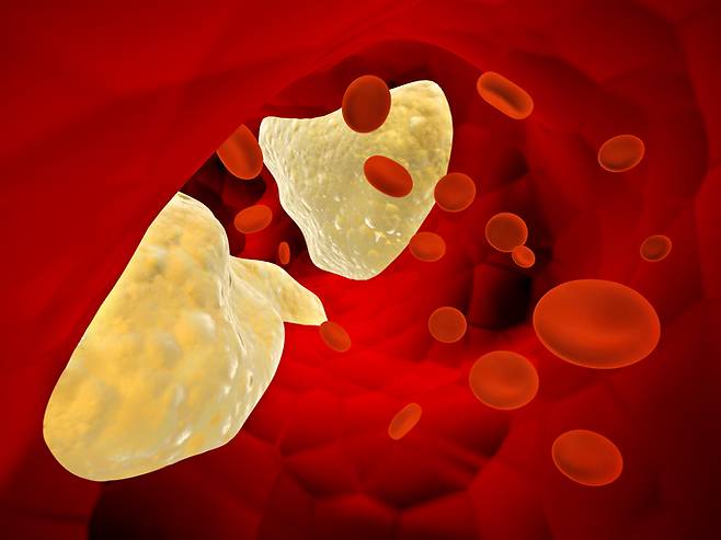 혈액 내 콜레스테롤 플라크가 침착된 모습 [사진=frentusha/게티이미지뱅크]
