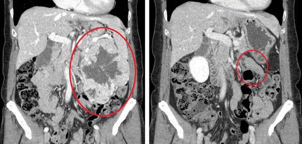 21cm까지 커진 신장암으로 모양이 변형된 홍 씨의 신장 CT(왼쪽)와 로봇수술로 신장암 제거 3개월 후 정상 모습으로 회복된 홍 씨의 신장 CT 사진. 순천향대 부천병원 제공