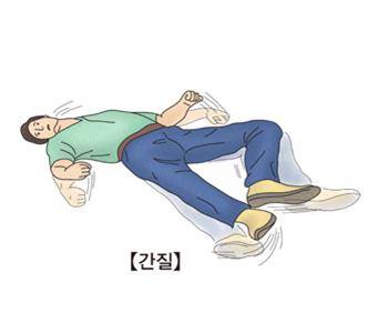 경련 발작 [출처: 서울아산병원]