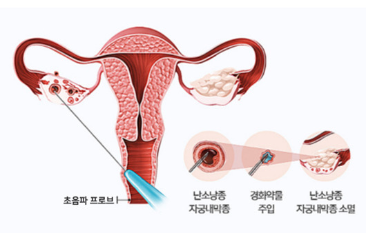 특수 바늘을 이용한 경화술 치료 모습 예시ㅣ출처: 최상산부인과의원