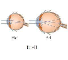 난시 [출처: 서울아산병원]