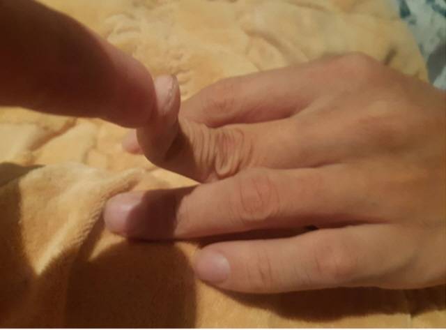 엘러스 단로스 증후군에 걸리면 관절이 비정상적으로 유연해지고, 피부가 종이처럼 약해진다. 손가락이 뒤로 180도 이상 꺾일 수도 있다./사진=2022년 대학내과학회지 논문 '신장 경색으로 발현한 혈관형 엘러스 단로스 증후군 1'