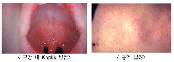 홍역에 감염된 사람의 구강과 피부 모습. 사진 미국 질병관리본부(Centers for Disease Control and Prevention)