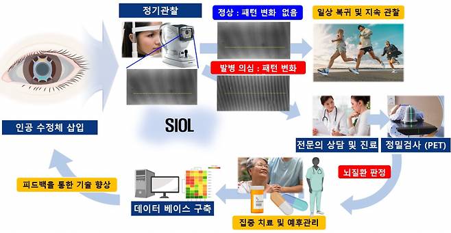 스마트 인공수정체 퇴행성 뇌질환 조기 진단 활용 방안.[한국기계연구원 제공]