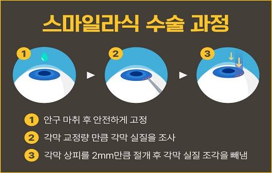 스마일라식 수술 과정ㅣ출처: 에스앤유안과의원