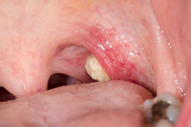 편도결석/사진=클립아트코리아