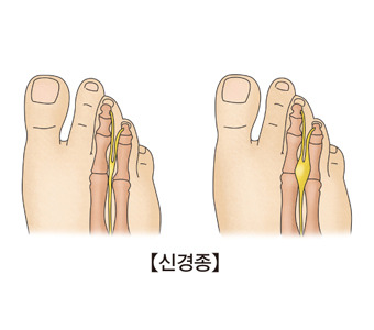 지간신경종 질환도 [자료=서울아산병원]