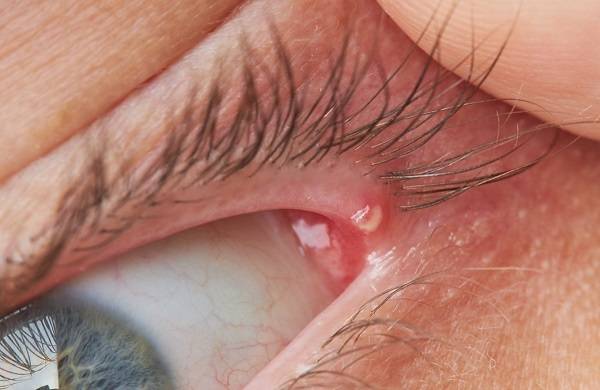 안검염ㅣ출처: 게티이미지 뱅크