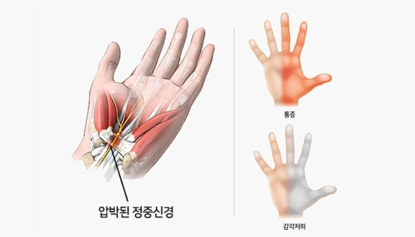 '손목터널 증후군' 증상이 진행 중인 손의 모습.