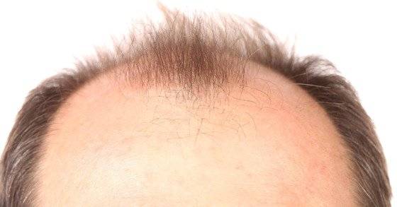 머리카락은 동성에게는 힘을, 이성에게는 매력을 어필하는 수단이다. '탈모'가 개인에게 미치는 심리적 영향에 대한 인식이 커지면서 과거에는 모욕이나 명예훼손으로 인정받지도 못하던 '대머리'가 이제는 종종 모욕의 사례로 판결문에 등장하고, 탈모치료를 위한 시술과 수술로 인한 송사에서도 손해배상 판결이 나는 경우가 다수 생겼다. 중앙포토