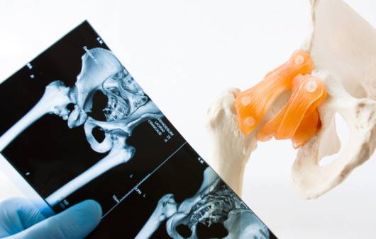 고관절ㅣ출처: 게티 이미지뱅크