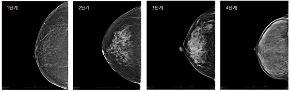 실질조직에 따른 치밀유방 정도/일산차병원 제공