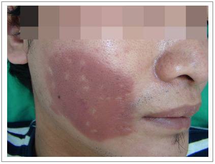 2019년 국내에서 보고된 신규 한센병 환자의 증상 모습. [사진=질병관리청]