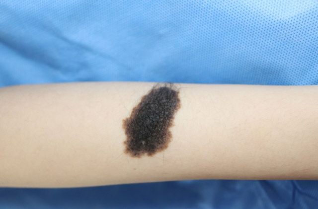 거대 선천성 멜라닌 색소 모반은 흑색종을 유발할 수 있으므로 조기에 적극적으로 치료해야 한다./사진=가천대 길병원 제공