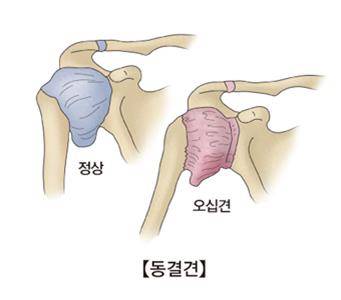 동결견(오십견) [출처: 서울아산병원]
