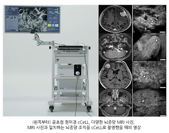 '씨셀' 기기의 모습(왼쪽)과 MRI와 씨셀로 각각 촬영한 뇌종양 조직 영상. [사진=고대안암병원]