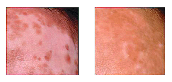 소아 백반증 치료 전(왼쪽)과 후의 피부.