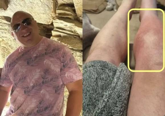 경기장에 있던 ‘개똥’ 때문에 봉와직염에 걸려 다리 절단 위기에 놓인 럭비 선수 사연이 전해졌다. 데일리스타 캡처