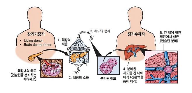 동종 췌도이식 개념도/ 제넨바이오 제공