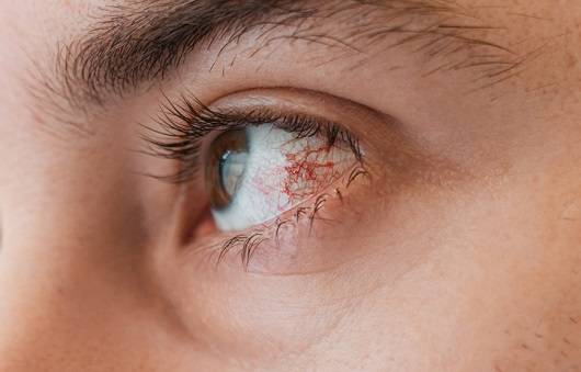 충혈ㅣ출처: 게티이미지뱅크