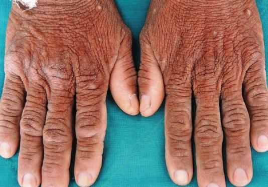 흑색가시세포증이 발생한 손등/사진=Tripe Palms and Acanthosis Nigricans: A Clue for Diagnosis of Advanced Pancreatic Adenocarcinoma(2019 Indian Dermatol Online J.)