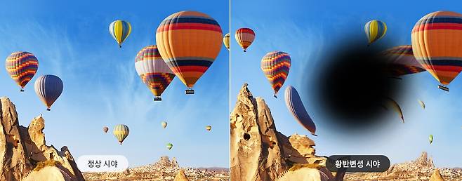 출처: 비앤빛강남밝은세상안과