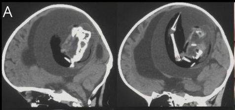 중국의 한 갓난아이 두개골에서 발견된 기생 태아. /@GreenJournal 트위터