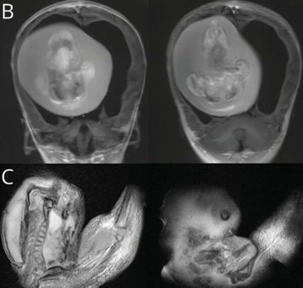 중국의 1살 여아 두개골에서 발견된 기생 태아. (사진=@GreenJournal 트위터)