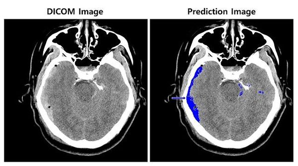 뇌출혈이 의심되는 환자의 뇌 CT 영상(왼쪽)과 뇌출혈 영상 판독 AI 모델이 식별한 영상(오른쪽)./조선DB