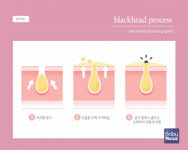 좁쌀여드름은 바로 우리가 알고 있는 '화이트헤드'이다. 화이트헤드는 블랙헤드와 그 뿌리가 같다. ⓒ베이비뉴스