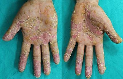 농포증이 나타난 환자의 손바닥 모습. 농포증으로 인해 피부 각질이 갈라지면 가려움증에 이어 통증까지 생길 수 있다.&nbsp; &nbsp;건국대학교병원