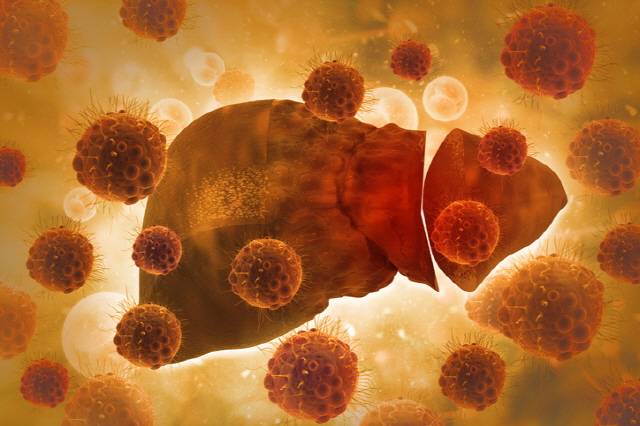 간 절제를 통해 간암을 제거했다해도 간염 등 기저 간 질환 계속해야 한다. /게티이미지뱅크