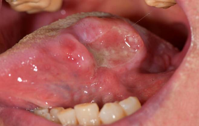 설암이 진행된 사례 [사진=서울대치과병원]