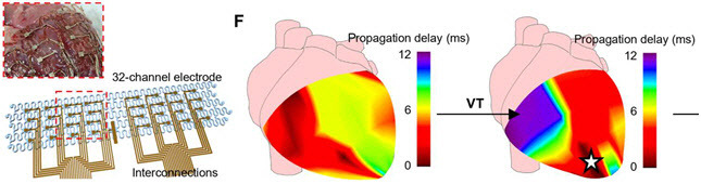 다채널 전극 어레이와 이의 부정맥 진단 능력 검증. (좌) 8×4다채널 전기 자극 어레이의 모습. (중, 우) 32개 전극 채널로 심실 전기 신호를 측정하고 매핑한 결과, 심실빈맥 증상 발생 시 전기 신호를 바탕으로 부정맥이 시작되는 부위(흰색 별)를 확인하고 부정맥이 어떻게 전파되는지 알 수 있었다.