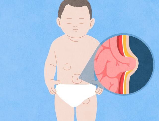 배꼽염이 적절히 치료되지 않은 경우 전신으로 균이 퍼져 패혈증이나 수막염이 생길 수 있다. 이미지투데이