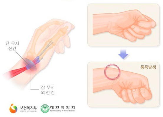 손목건초염이 발생하는 부위. 보건복지부 제공