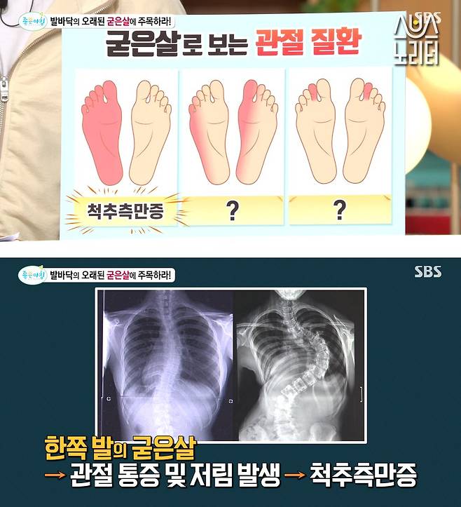 발바닥에 굳은살이 있다면 봐야 하는 글 ㄷㄷ | 스브스노리터